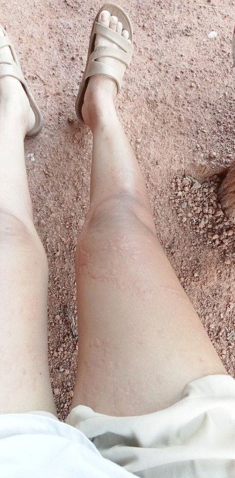 ท้อง 8w เป็นผื่นขึ้นตามตัว