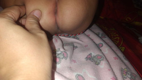 bun,mau tnya ini apa termasuk ruam popok y