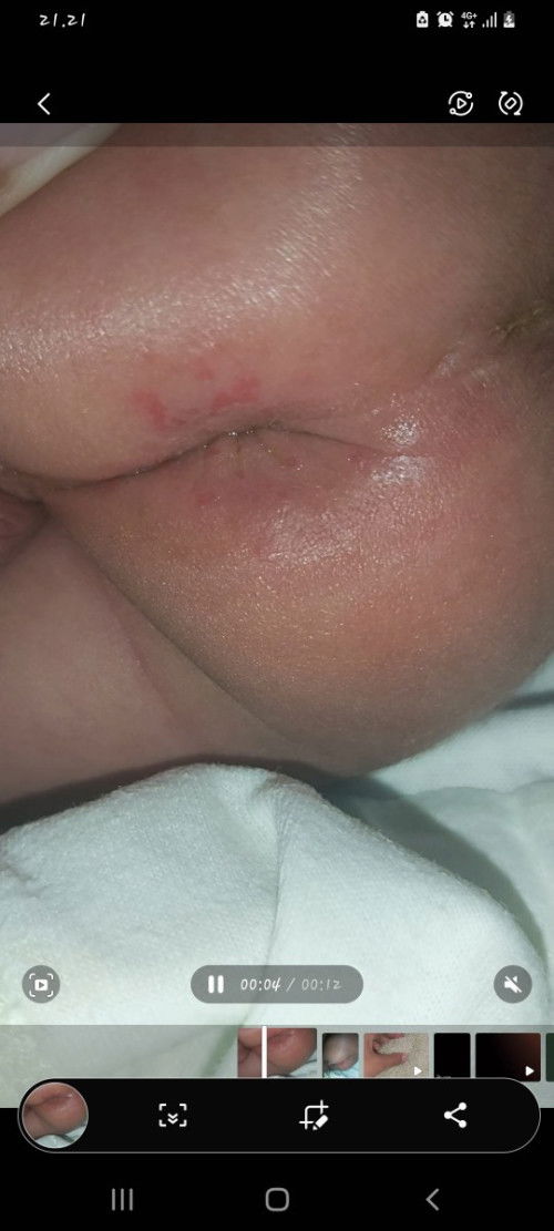 Ruam pada pantat bayi