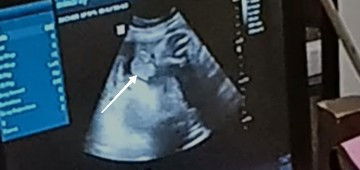 bagi pengalaman tentang USG bund