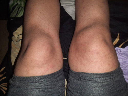 Ada yg pernah sakit lutut ga bun?