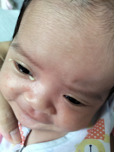 ทารกตาแฉะข้างเดียว