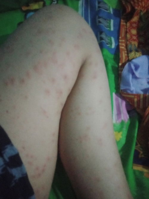 Gatal setelah melahirkan