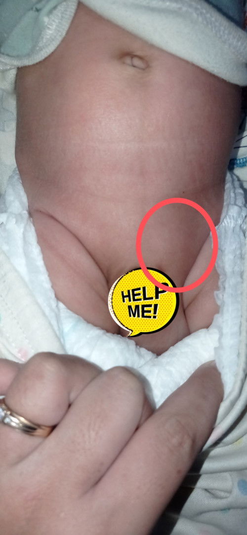 Benjolan di penis  bayi