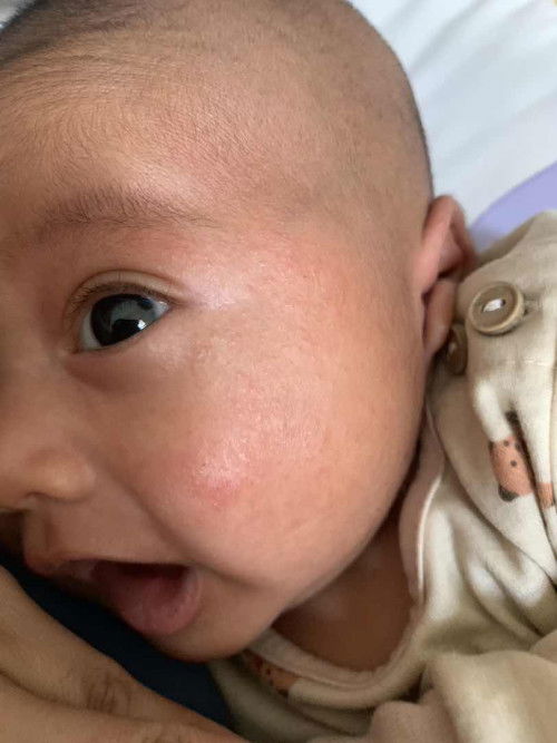 Pipi anak ruam merah