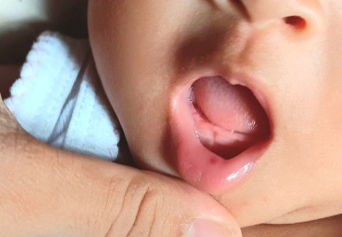 Bintik merah dibibir bayi 4 bulan