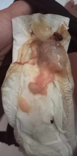 ท้อง40+5 เมื่อวานไปกระตุ้นมาแล้วรอบนึง