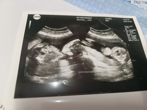 Scan baby 21 weeks nmpk seperti gastroshisis