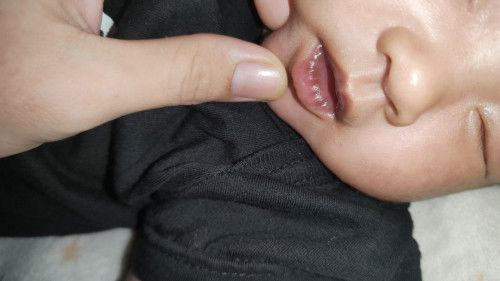 Bibir bayi menghitam