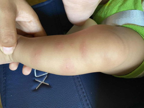 Kaki bayi ada ruam bintik merah