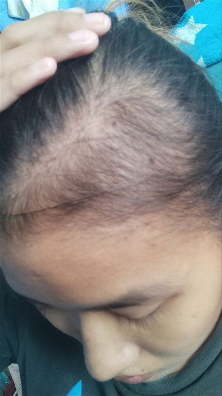 ผมร่วงหลังคลอด