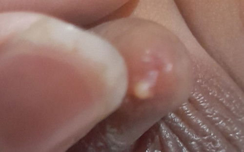 Di ujung burung si kecil ada seperti jerawat matang?