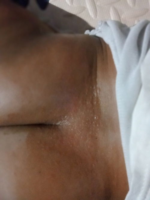 bruntus merah di pantat bayi 7 bulan