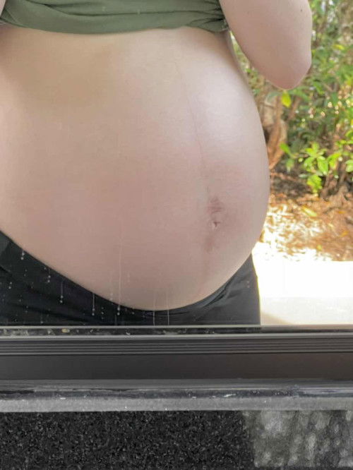 ท้องตรงไกล้ๆสะดือ