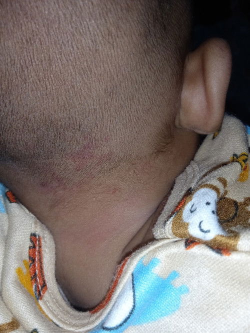 Merah merah di kepala