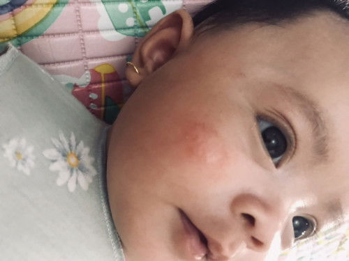 Ruam di pipi bayi