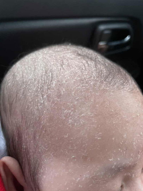 หัวของลูกลอกแบบนี้