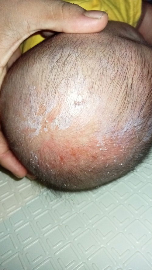 Kulit kepala melepuh