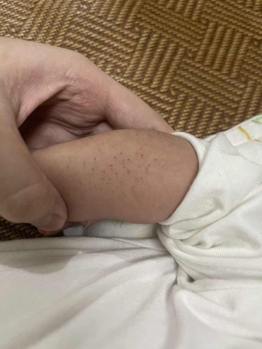 Các mom e hỏi với ạ con em tự dưng lông nó bị như thế này sần có mom nào con bị ntn k ạ