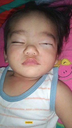 Allergies (imon-imon)