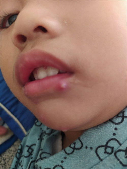 Bentol seperti ada nanah nya