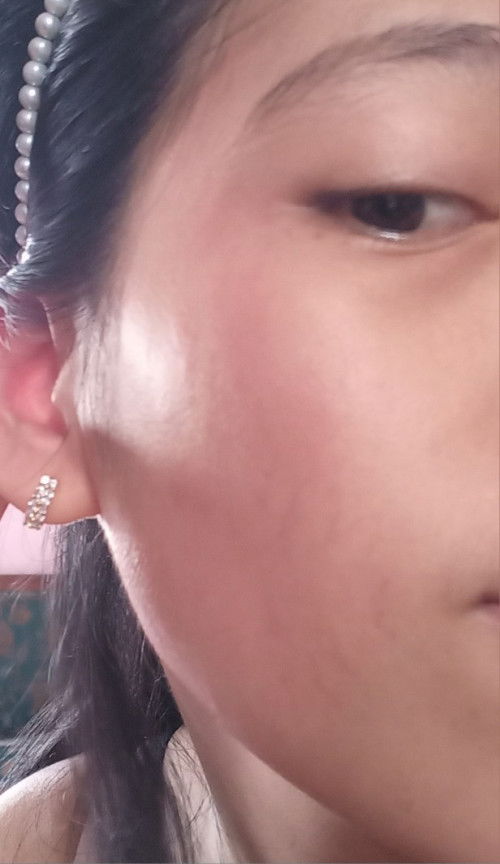 Gatal2 kemerahan pada wajah dan badan bunda setelah melahirkan