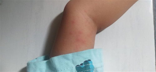 Bintik merah pada baby