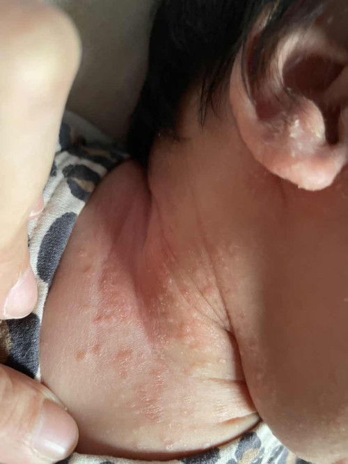 Baby rash on neck