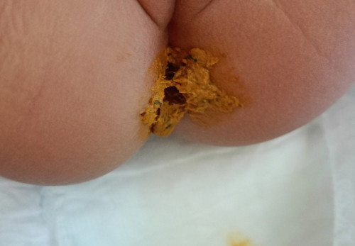 ลูก 6 เดือนกินอาหารแล้วไม่อึ