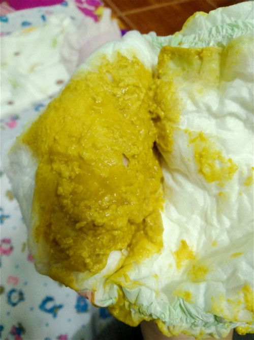 ลูกน้อยถ่ายมีมูก