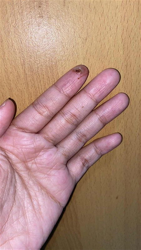 Keputihan 
Perut tidak sakit