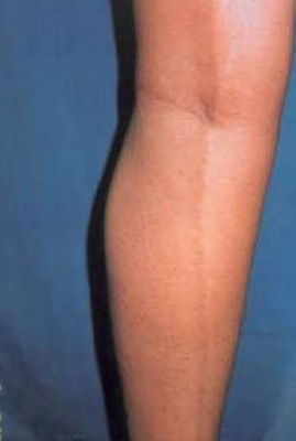 Linya sa likod ng binti