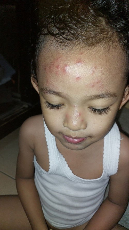 Bintik merak seperti jerawat dan biang keringat