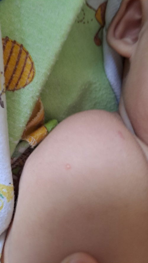 Muncul bentol berair