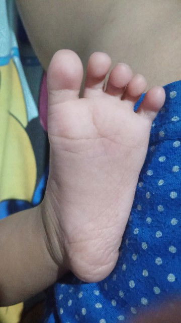 Anakku usia 6bulan di diagnosa BRAIN ATROPHY