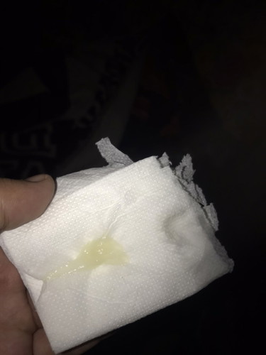 Milky discharge