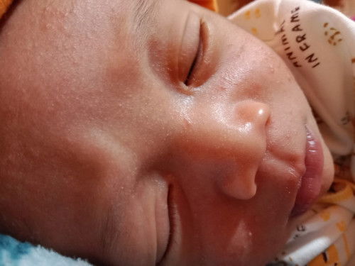 Bintik merah di wajah