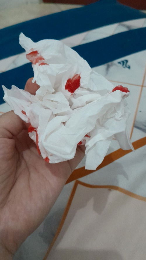 Mimisan di week 27, bahaya ga?