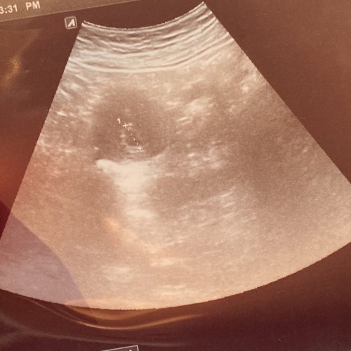 Hi nak minta kongsikan pengalaman saya scan tapi bila tanya doc twin atau seorang