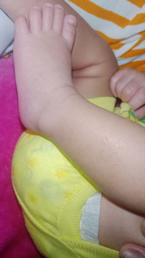 Dri sabun cair pindah sabun batang jdi sprt itu, Apa itu termasuk ruam bun?? 
Atau cma gk cock sbun?