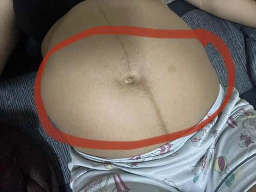 แยกไม่ออกนะหว่างท้องแข็ง กับท้องปั่น