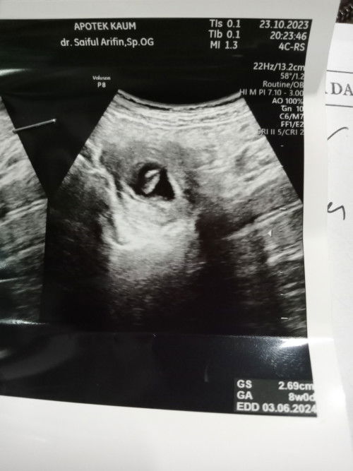 Adakah bunda disini pendarahan saat hamil 6w sampe sekarang (8w)