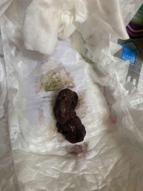 sembelit atau normal