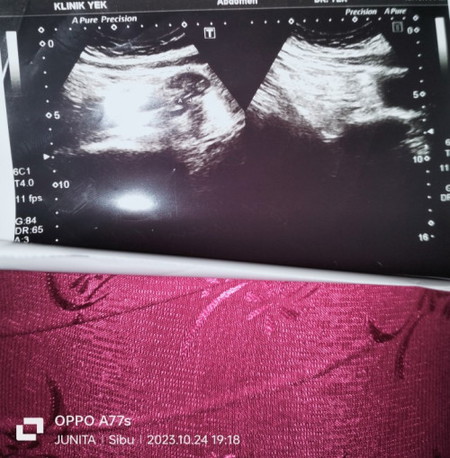 Apakah ini hamil atau tidak bunda