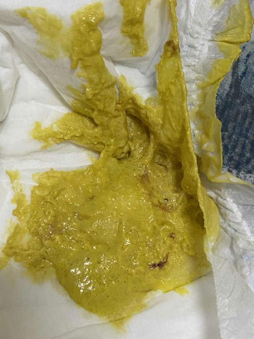 น้องอายุ 1เดือน 25 วัน กินนมแม่ล้วน มีถ่ายเหลวลักษณะแบบนี้ปกติไหมคะ กังวลมากๆค่ะ (มีรูป) ขออภัยค่ะ