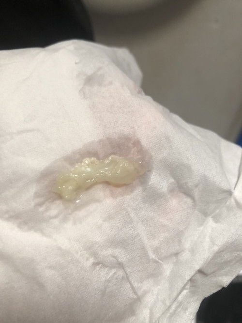 Ini mucus plug atau keputihan?