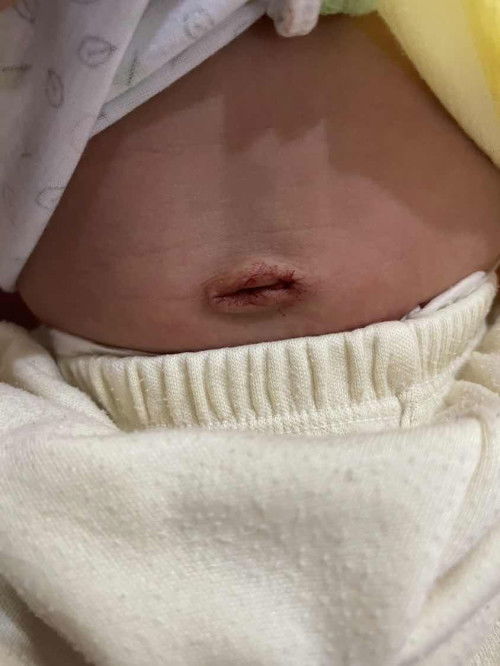 สะดือลูกหลุดแล้ว แต่มีเลือดซึมออกมาแบบนี้ปกติไหม?