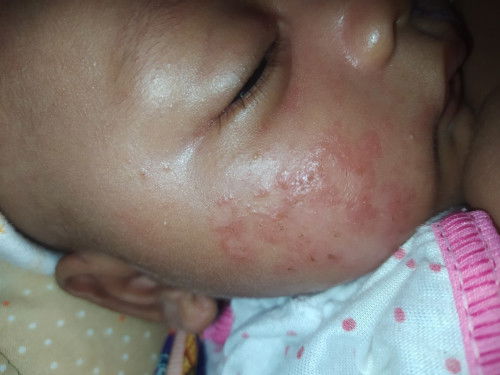 Ruam pipi tampak kemerahan