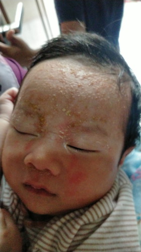 Kulit bayi merah merah