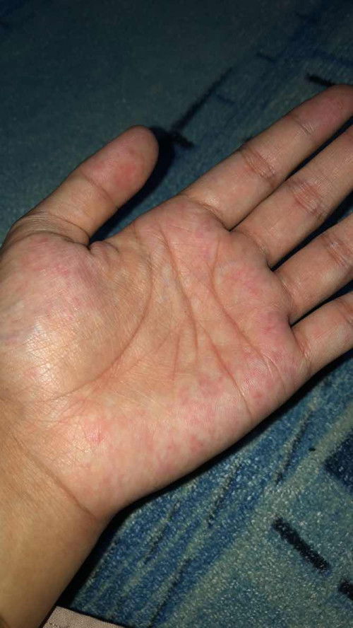 Ruam di telapak kaki dan telapak tangan